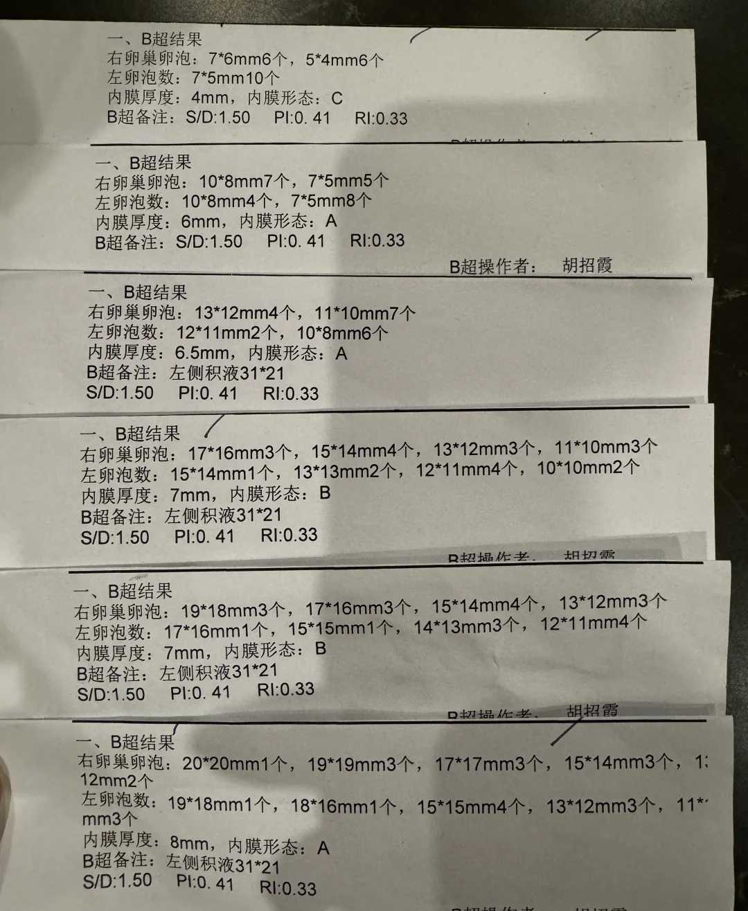 卵巢炎影响做试管吗吗(卵巢炎影响排卵吗)