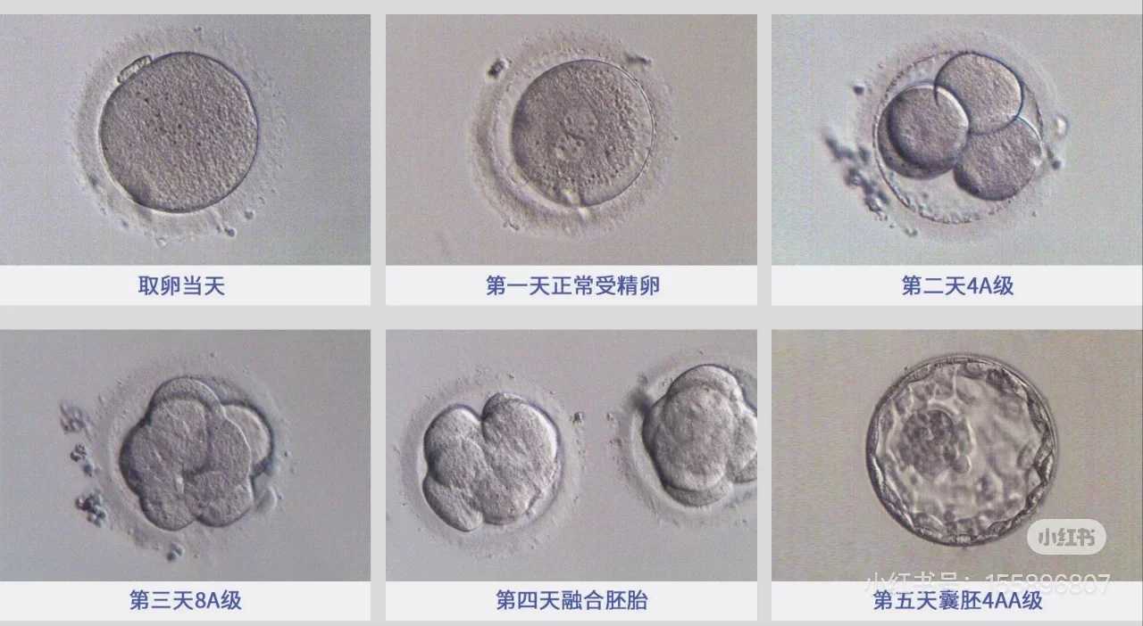 助孕包成功机构,子宫内膜癌试管成功率高吗_子宫内膜癌成功案例！
